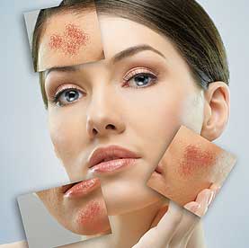 what causes rosacea